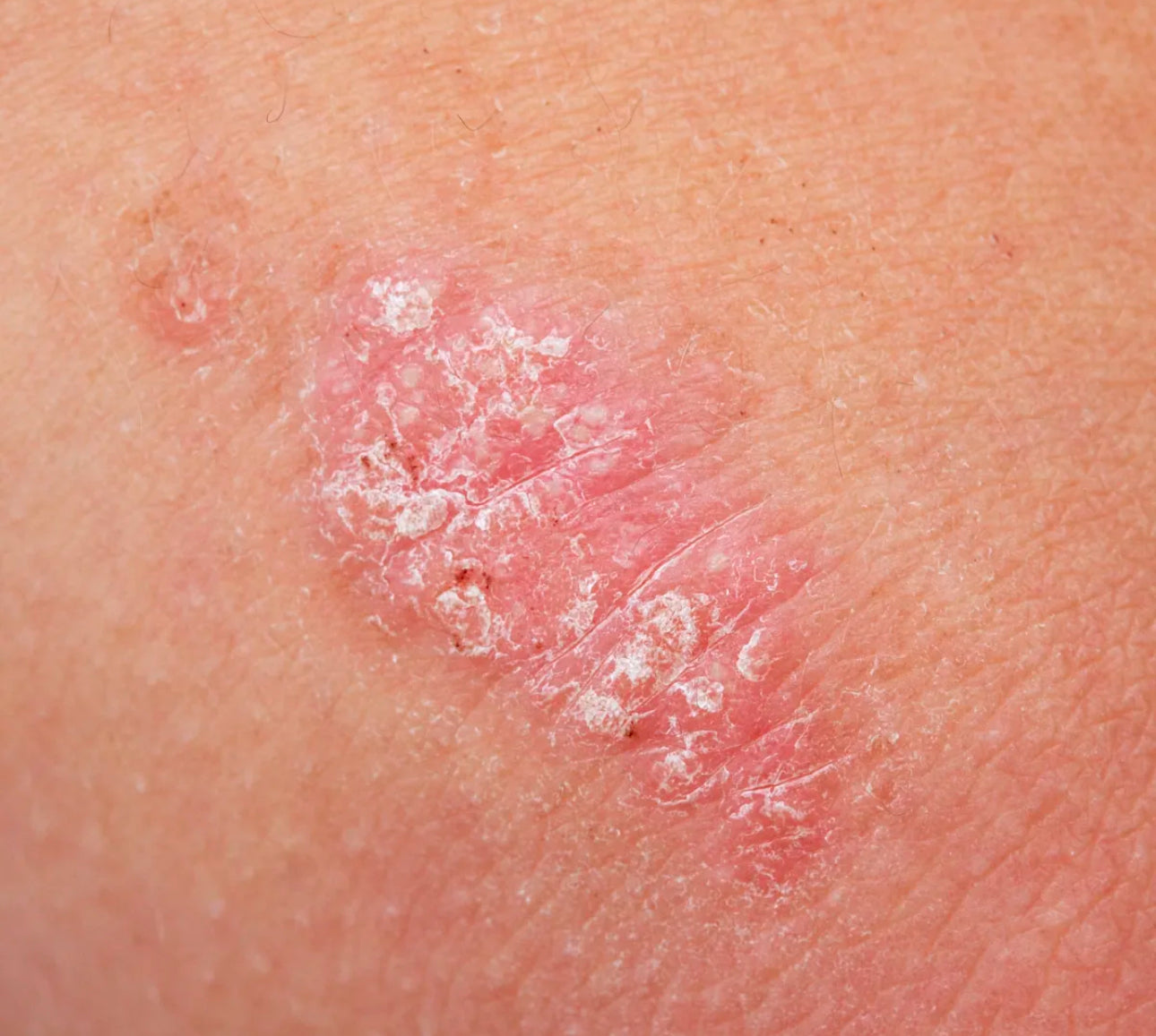 How to remove Psoriasis